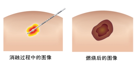 早期乳腺癌：无需手术 射频消融治疗成为微创新疗法，已纳入日本医保